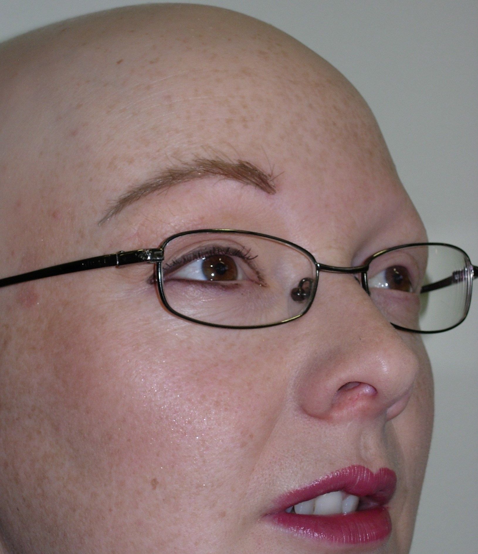 Alopecia areata