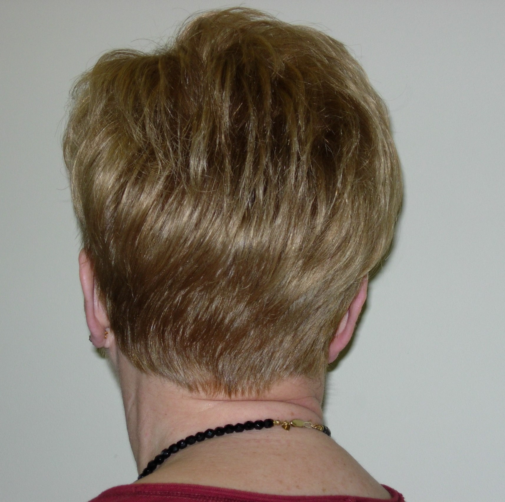 Alopecia androgenetica
