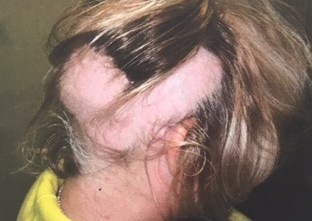 Alopecia areata