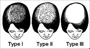 Alopecia androgenetica - verschillende types