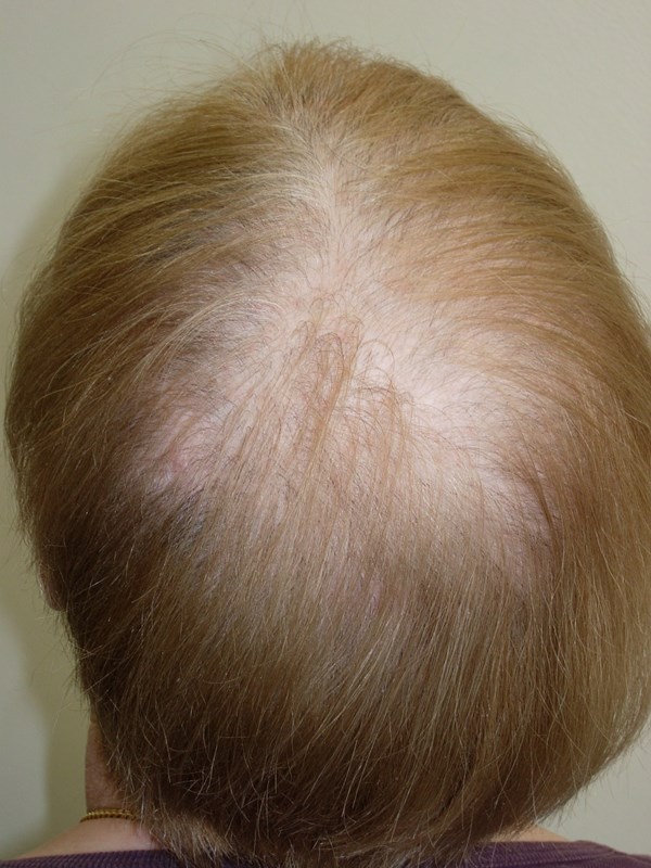 Alopecia androgenetica